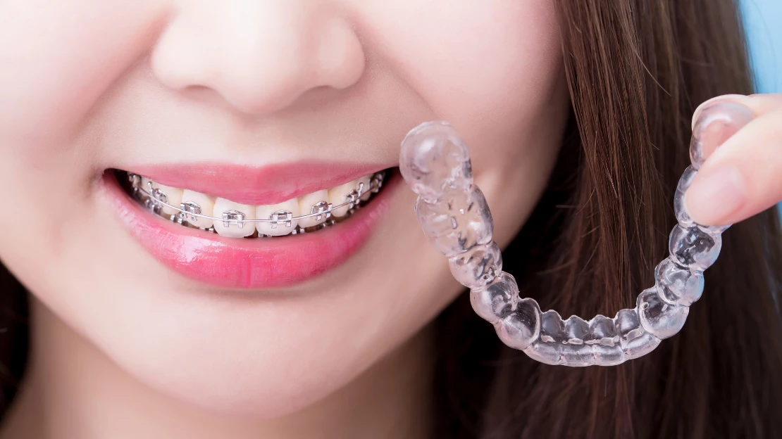 Invisalign